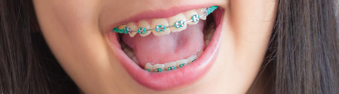 Image of a smiling mouth with braces